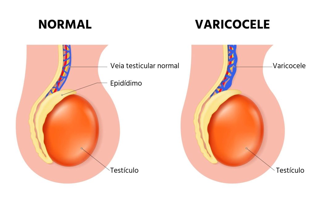 Ilustração comparativa de veia testicular normal x varicocele